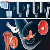 درمان ناباروری به روش iVF